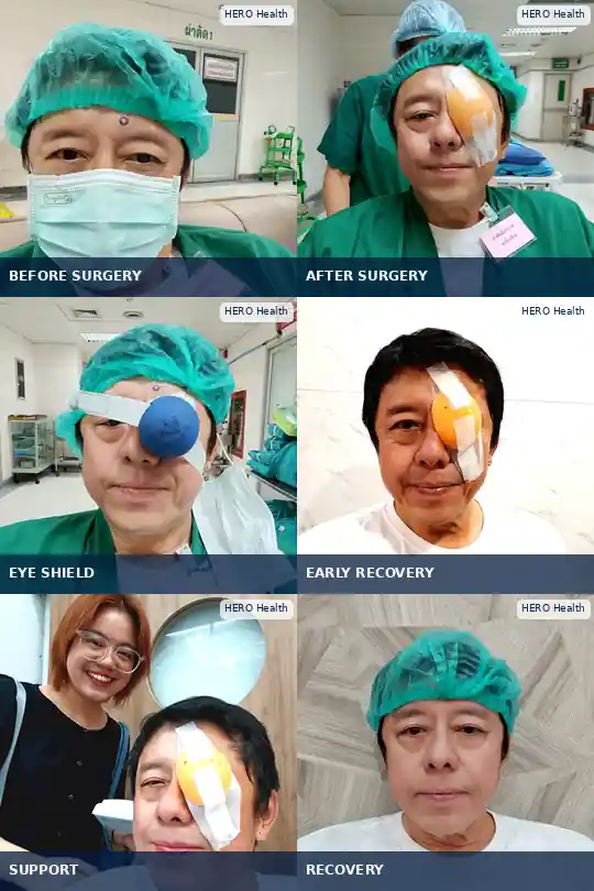 Vatistam Thomas PRUANGVIRIYA during his real cataract surgery journey in Thailand — before surgery, immediately after surgery, post-operative eye protection, family support and recovery